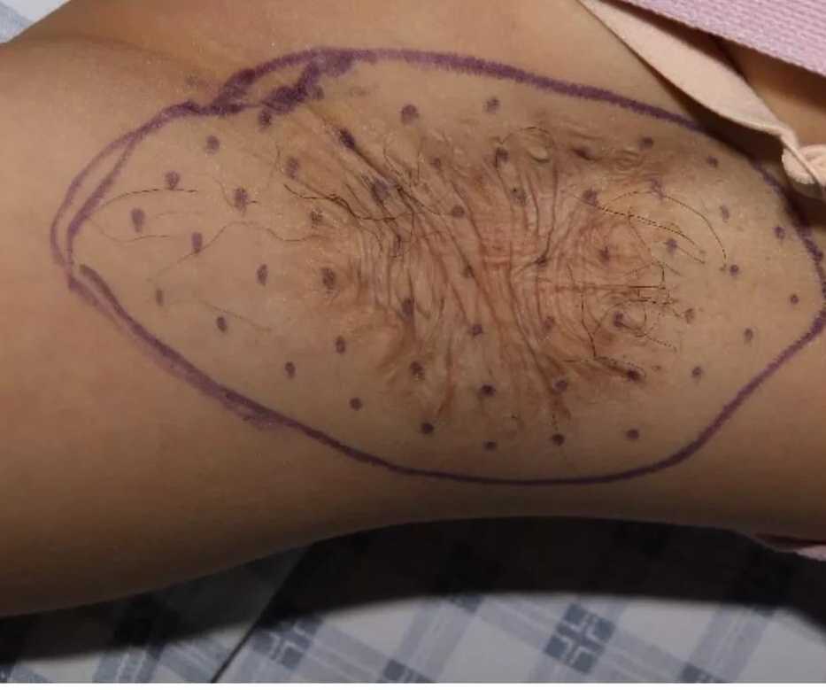 狐臭手术留下的疤痕怎么消除,狐臭手术留下的疤痕又痛又痒