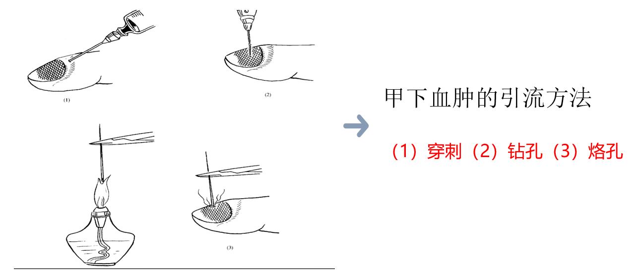 甲下积血放血后如何止血,甲下积血怎么办