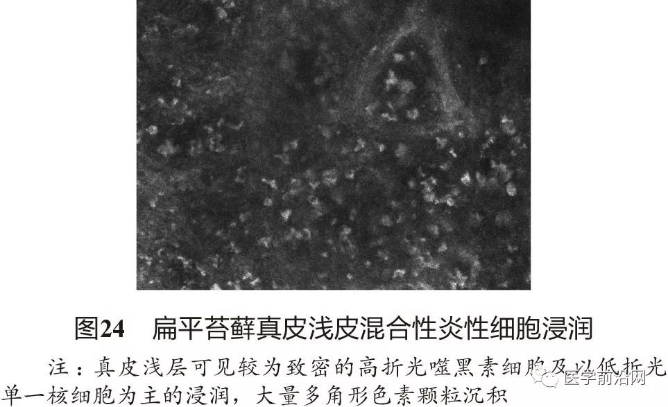 炎症性皮肤病反射式共聚焦显微镜诊断特征专家共识全文发布