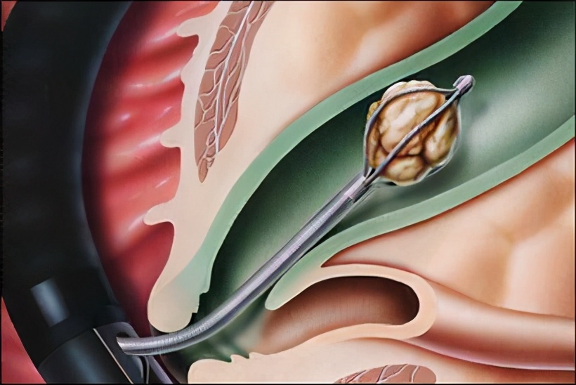 男性小腹胀痛伴随腰痛怎么回事,男性小腹痛是什么原因引起的