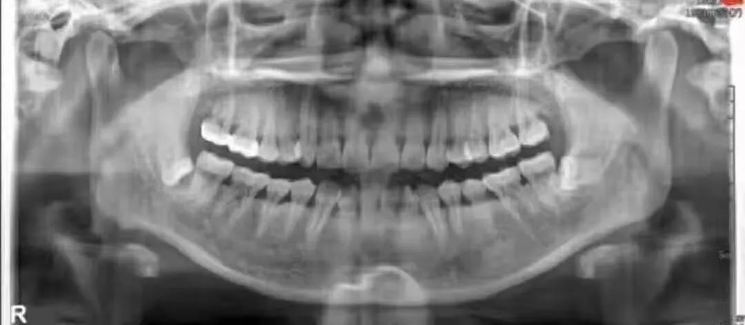 拔智齿是怎么算收费的,拔智齿是按智齿个数收费吗