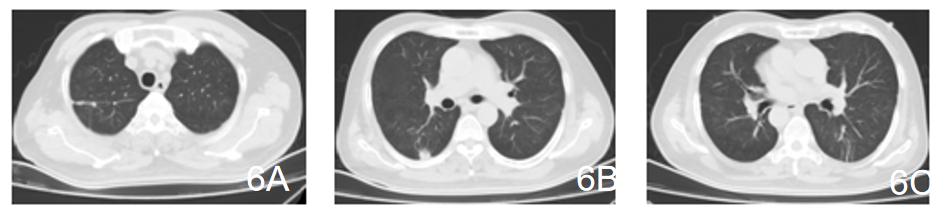 新冠症状容易与常见疾病症状混淆,症状和新冠一样怎么办