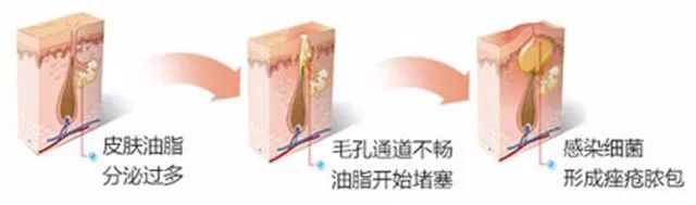 痘肌精华推荐祛痘印学生,油痘肌好用的祛痘精华推荐