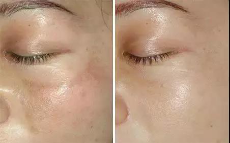 常见皮肤色斑有哪些如何鉴别,如何区分脸上色斑类型图片