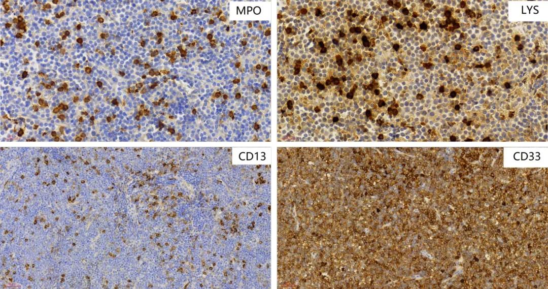 为什么会有t淋巴母细胞性淋巴瘤,t淋巴母细胞淋巴瘤真的治不好吗