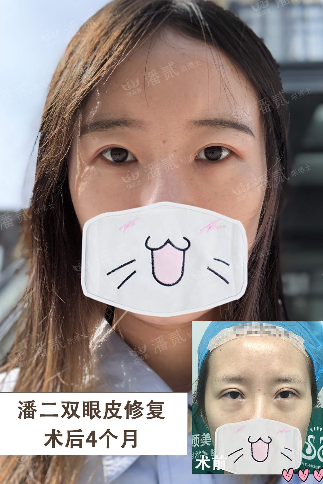 眼角下垂做双眼皮手术可以改变吗,后悔做双眼皮