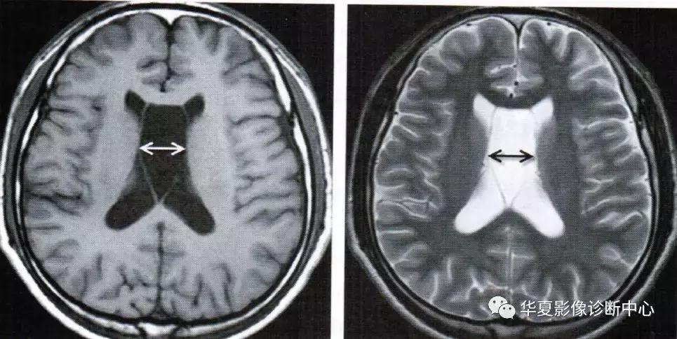透明隔腔与透明囊肿鉴别,透明隔间腔与囊肿区别