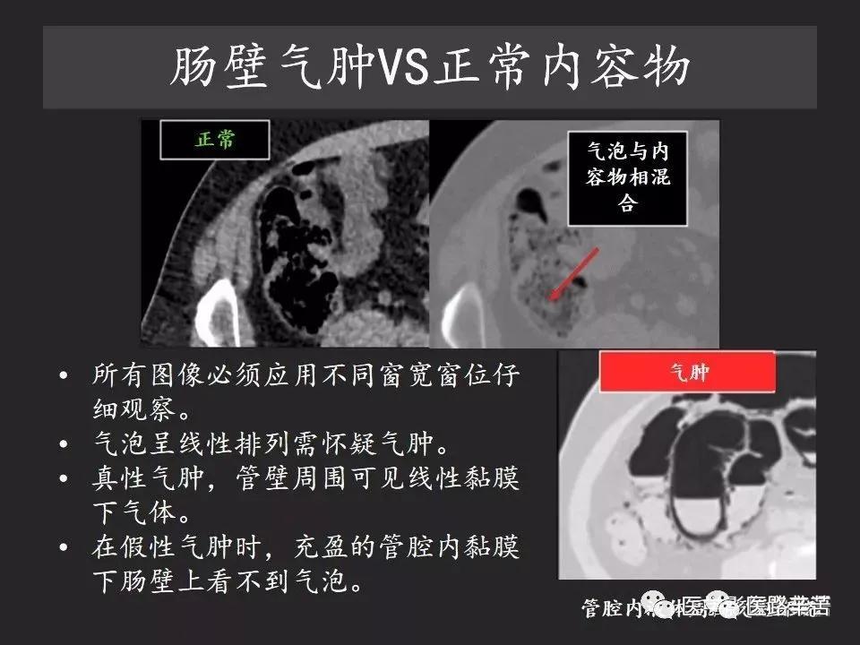 空腔脏器穿孔和胃肠道穿孔区别,腹膜后穿孔一般是哪里穿孔