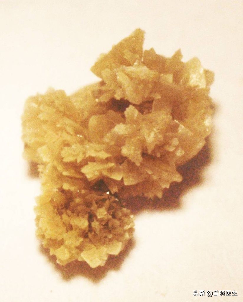 尿路小结石怎么治疗,为什么结石医生不建议做激光