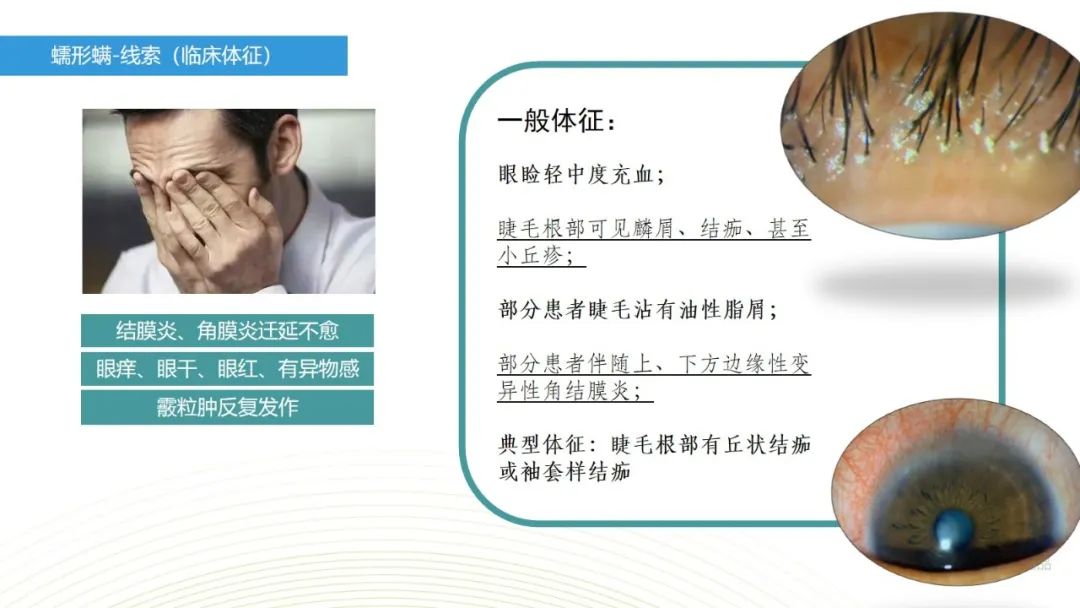 眼睛总是痒？总感觉眼睛里有东西？结膜炎角膜炎反反复复？可能是你的眼睛里有螨虫