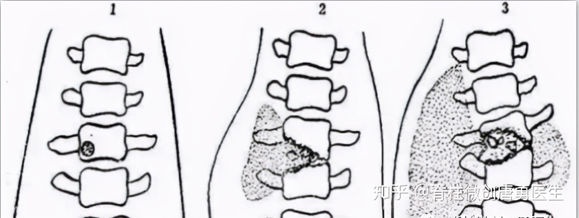 腰痛要警惕四种原因强直性脊柱炎,腰部脊柱结核是什么症状