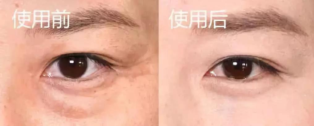 眼袋大显老试试这个方法简单实用,眼袋显老怎么办四种方法帮你去掉