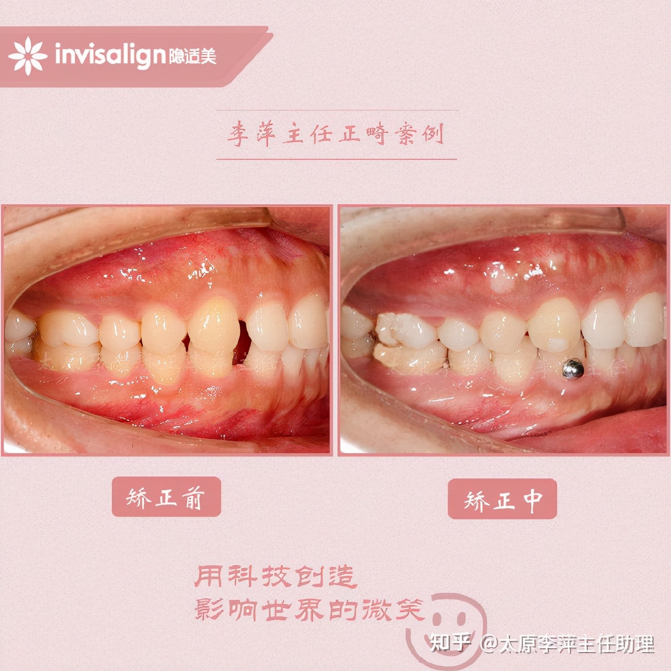 太原牙齿矫正靠谱吗,太原成人隐形牙套牙齿不齐