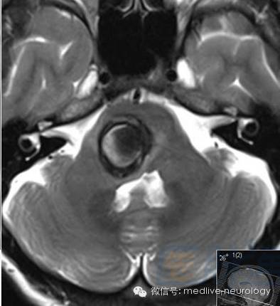 脑出血磁共振t1t2表现,10分钟记住脑出血核磁表现