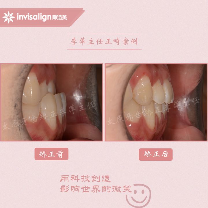 太原矫正牙齿需要做正颌吗,太原牙齿二次矫正