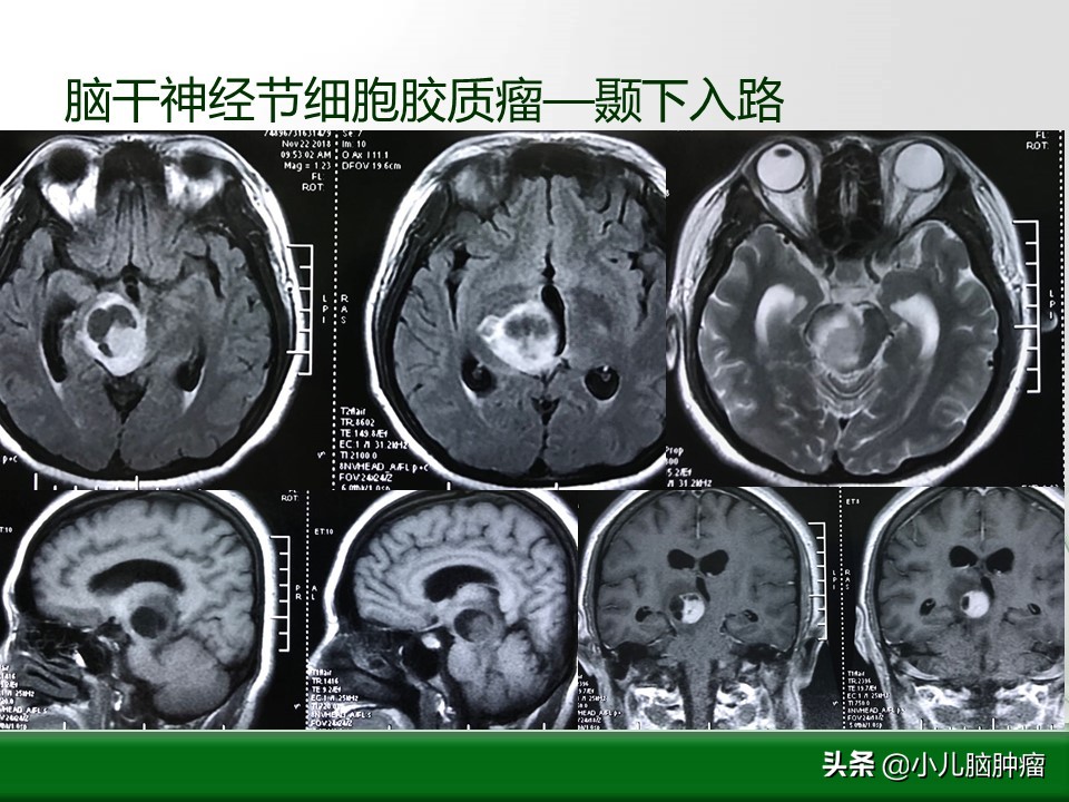 新疆脑干肿瘤手术,脑干肿瘤手术后遗症