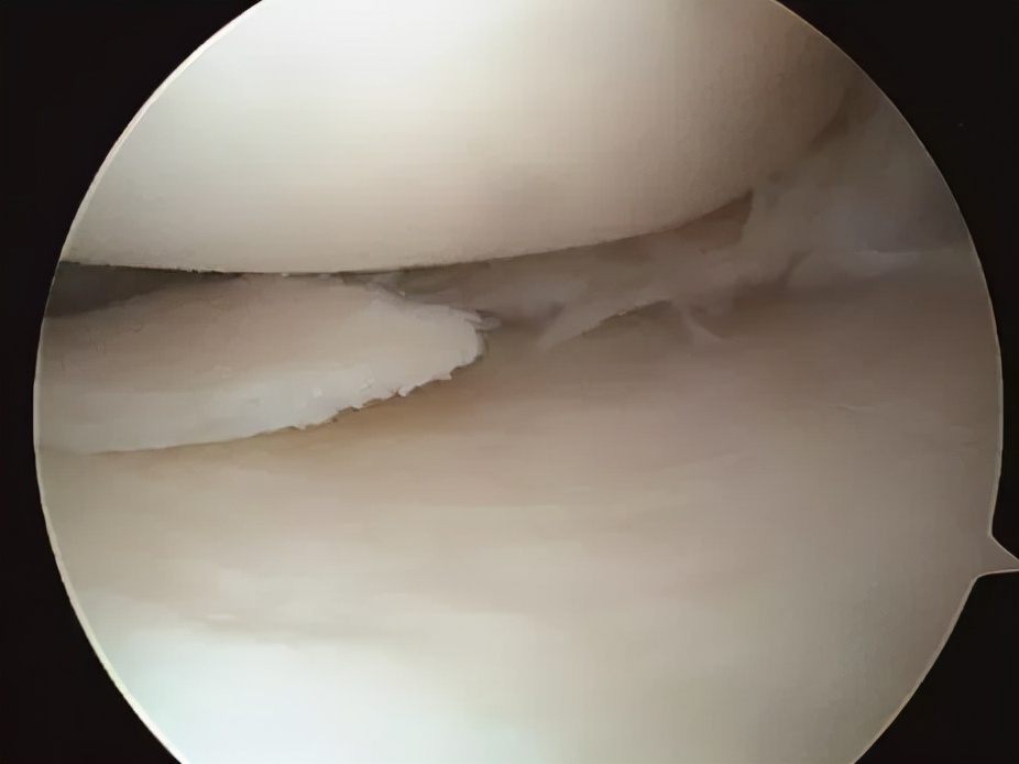 关节镜的适应症是什么,关节镜操作流程及注意事项