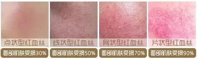 严重的红血丝泛红怎么治疗,红血丝泛红是因为什么