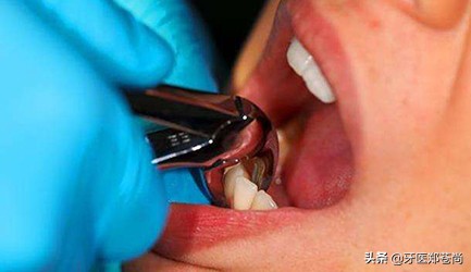拔完阻生智齿后多久可以正常吃饭,拔完智齿忌口食物