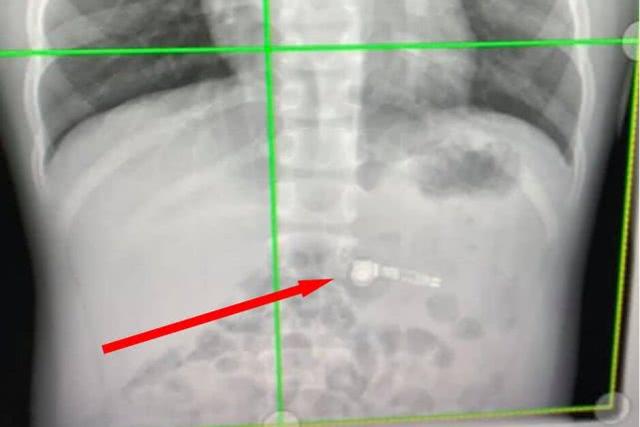 男孩误吞无线耳机,7岁男孩吞耳机