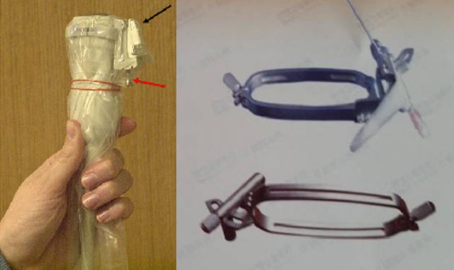 肾穿刺活检术住院多少天费用多少,肾穿刺活检术后护理