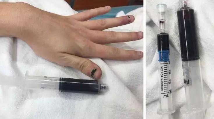 男子生殖器自燃的新闻,男性生殖器着火