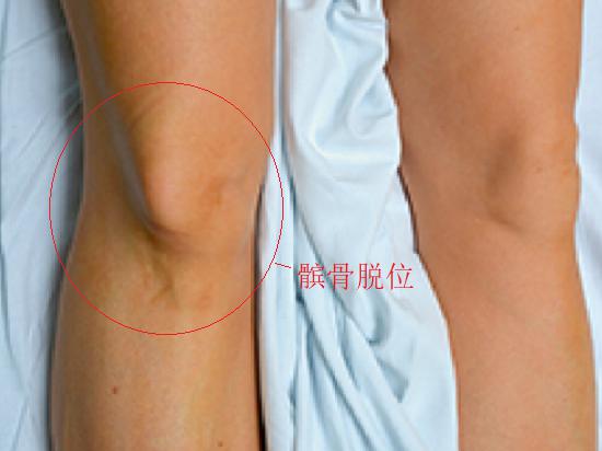 膝前疼痛,膝前痛危险因素