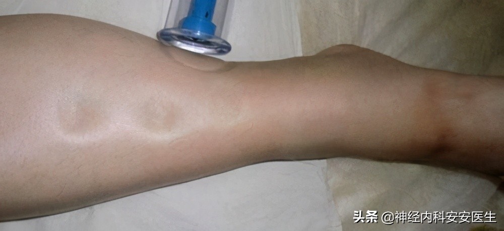 手脚浮肿发麻什么原因,手脚浮肿是什么原因吃什么中成药