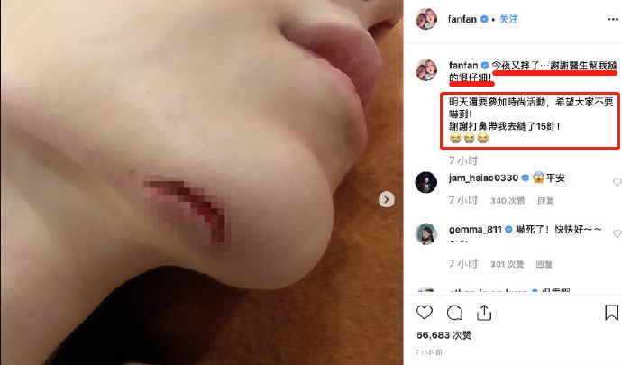 范玮琪摔跤反被疑怀孕，下巴皮开肉绽缝15针，还被骂炒作现世报