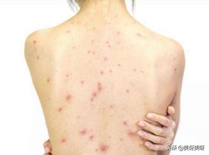 背后长痘痘怎么办最快最有效,背后长痘痘的原因和解决办法