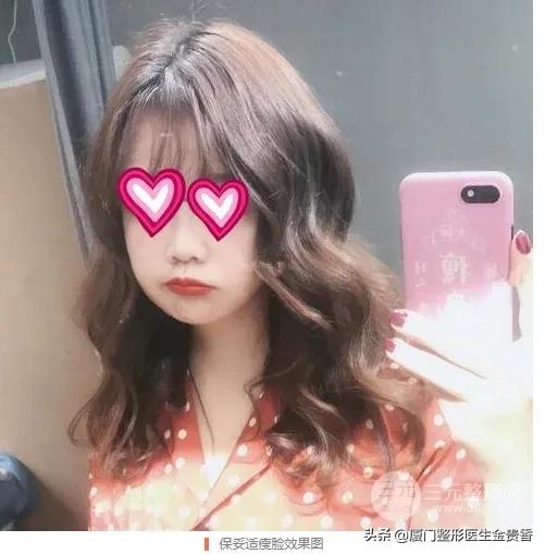 保妥适效果怎么样呢,保妥适是玻尿酸还是肉毒素