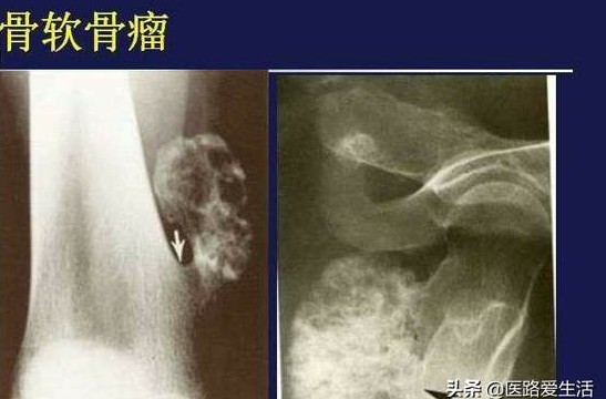 骨肿瘤能彻底治愈吗,骨肿瘤良性和恶性影像区别