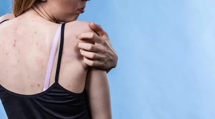 后背长痘最快最有效的方法,背部长痘的治疗方法