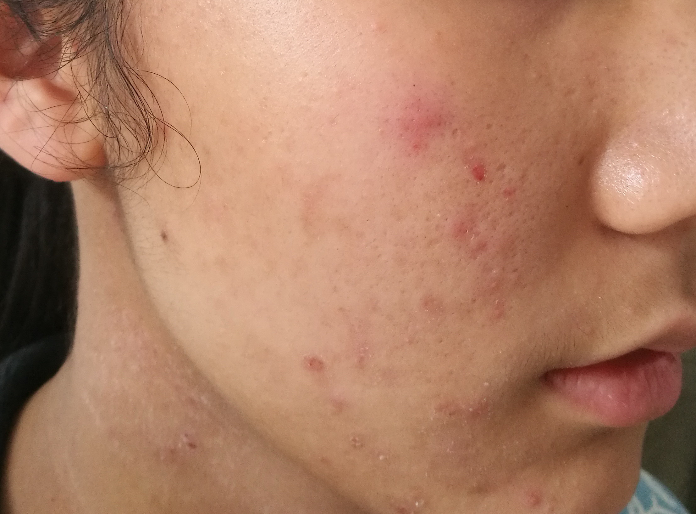 光过敏/多形性日光疹