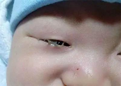 宝宝眼屎多真的是上火么原版,宝宝眼屎多是不是生病了