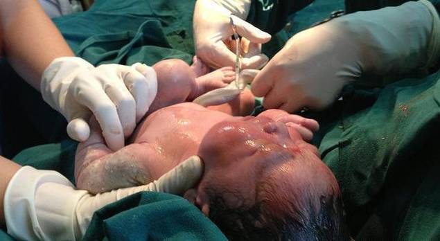 宝宝肚脐不闭合是什么原因,新生儿断脐后的肚脐眼