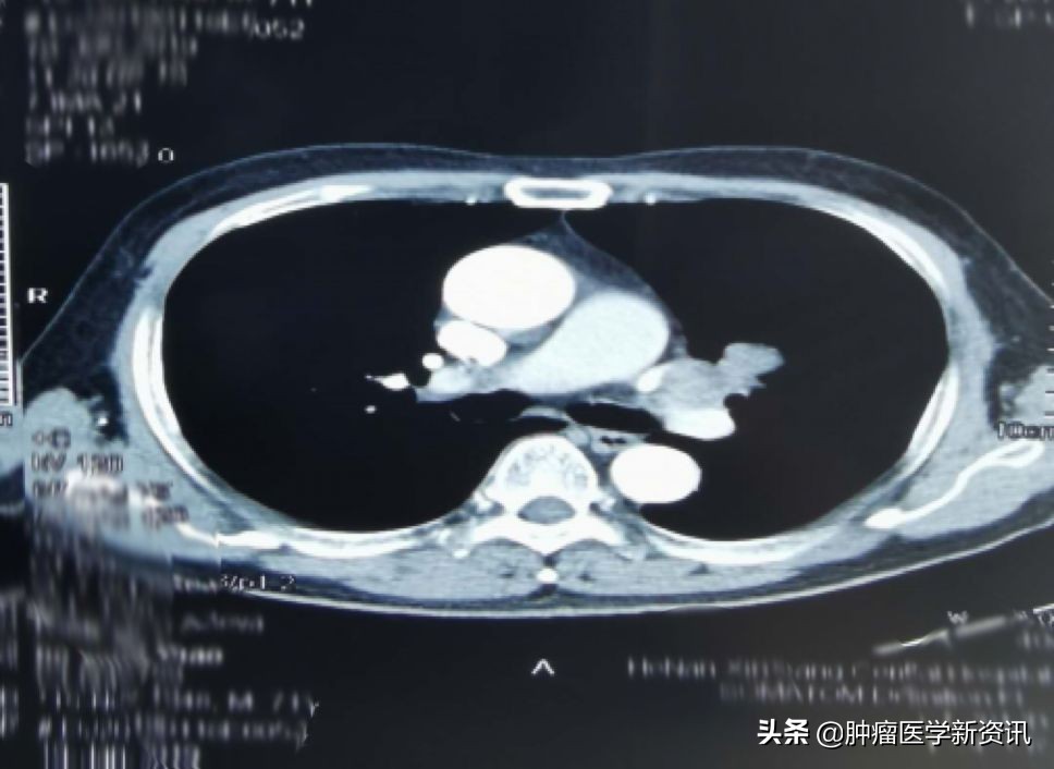 抗癌物质能治愈癌症吗,抗癌成功的几率有多大
