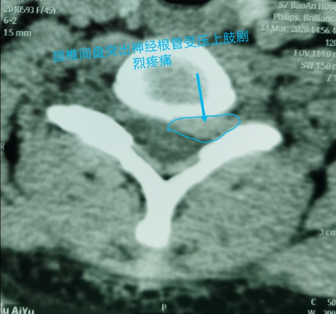疫情期间颈椎病发作怎么办,疫情间躺久了头昏眼胀怎么治