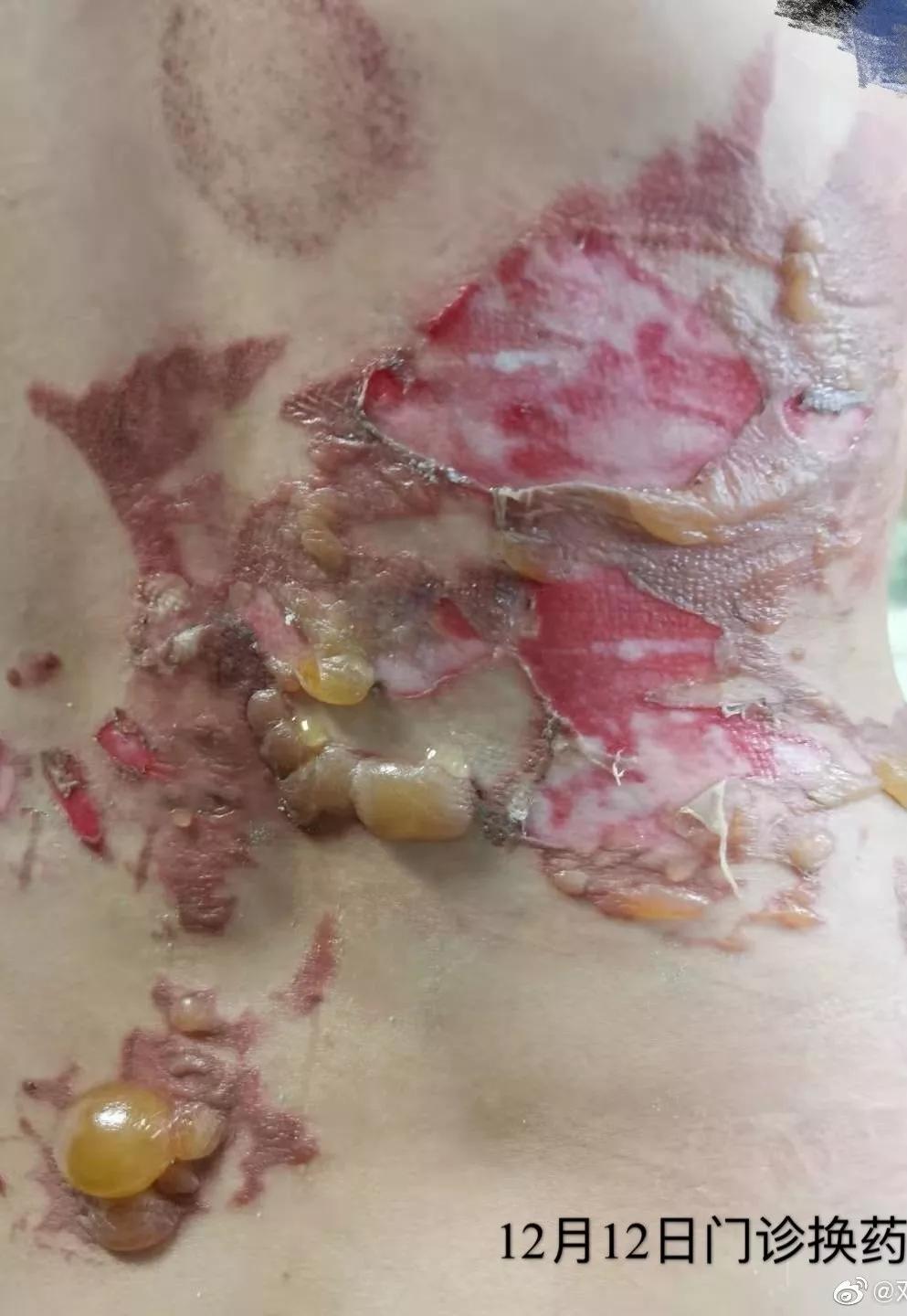 邓莎被烧伤原因,邓莎拔火罐被烧伤视频