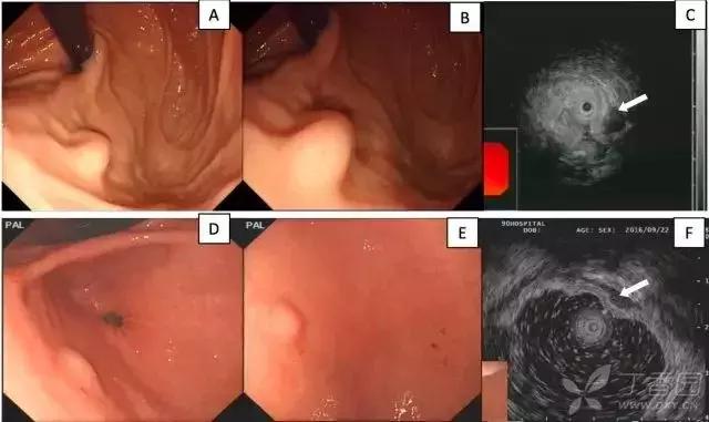 超声胃镜粘膜下隆起低回声占位,胃镜显示食道粘膜下隆起5mm