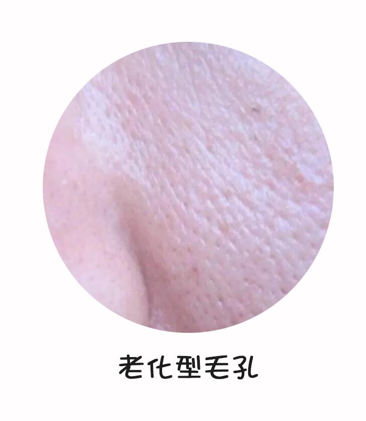 医美刷酸后爆痘期要多久,痘痘肌医美刷酸能好吗