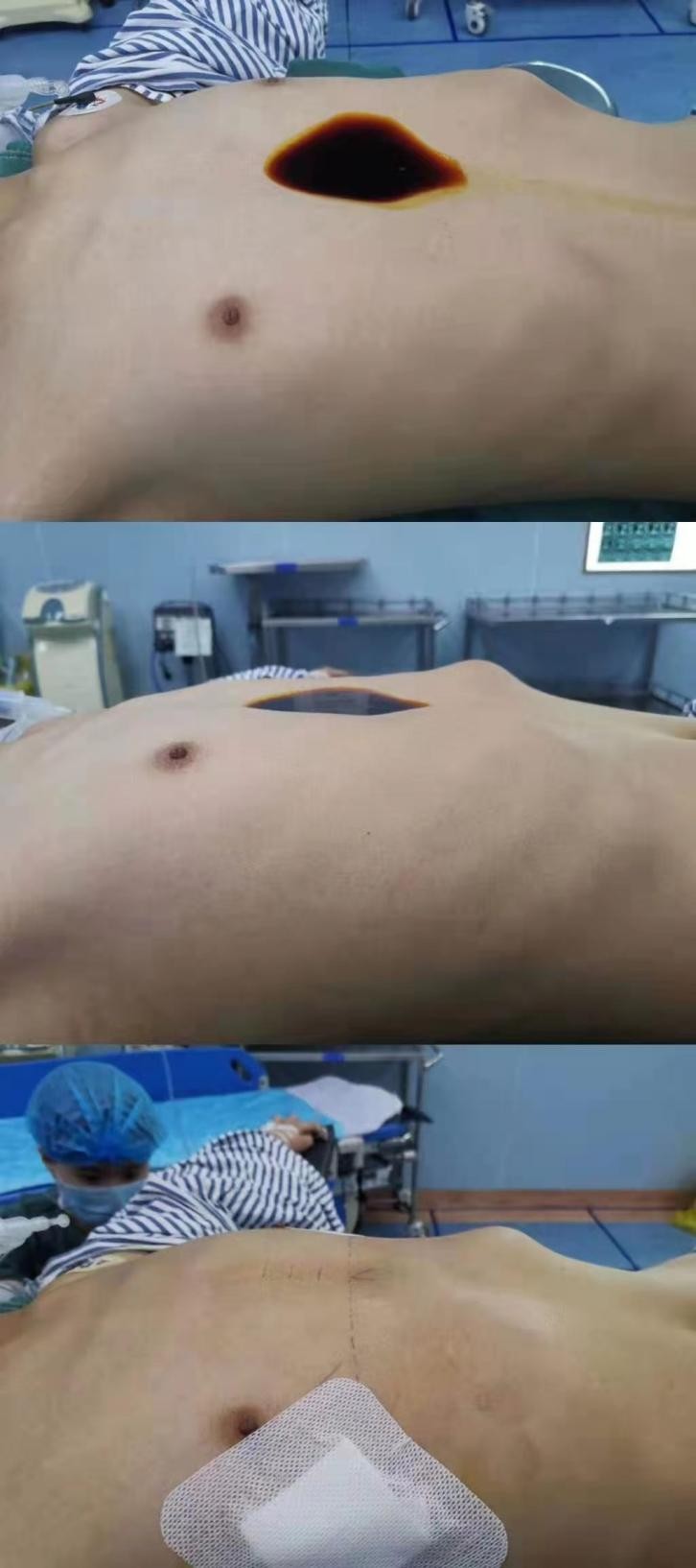 中国儿科医院漏斗胸,郴州市第一人民医院漏斗胸手术