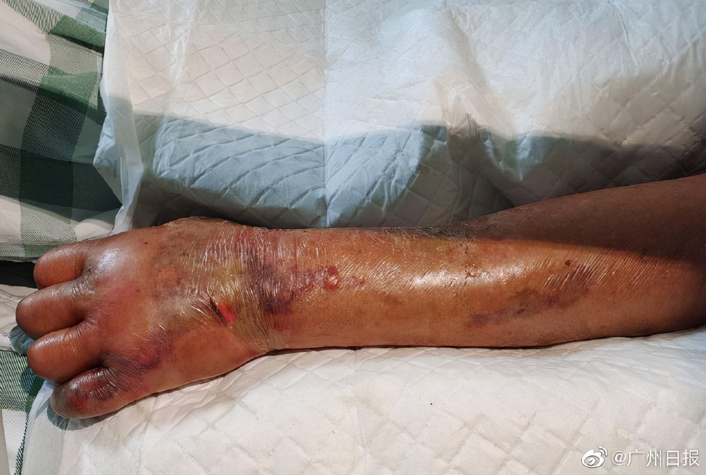 老人洗虾手指遭刺被迫截肢保命,洗虾被扎手多大概率死亡