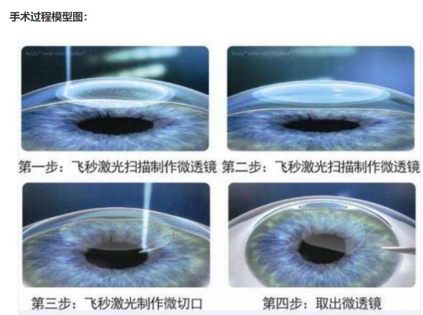 smile全飞秒近视手术,全飞秒准分子激光近视眼手术