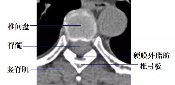 颈椎腰椎疾病ct及mri诊断,腰椎ct可以发现肠部病变吗