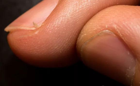 得了甲沟炎太疼了怎么办,甲沟炎疼痛难忍最有效办法