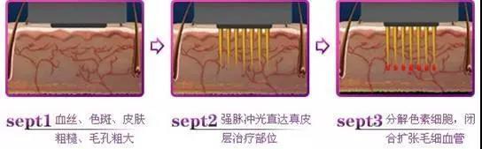 *血丝红**的自救指南,大家快来抄作业