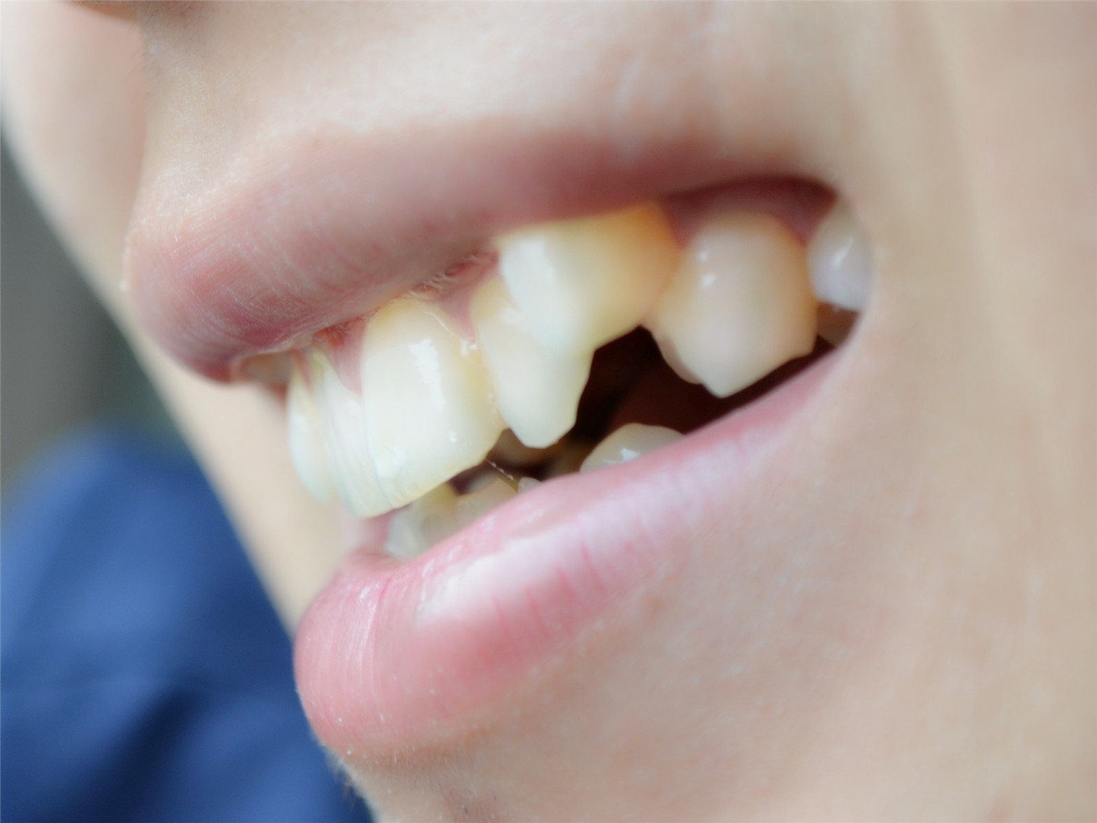 小孩大门牙缝里面发黑怎么办,牙缝靠近牙龈发黑是龋齿了吗