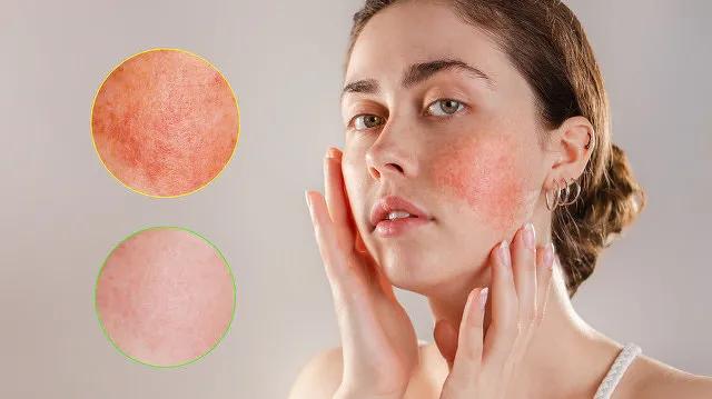 敏感肌自救宝典告别脸红,如何拯救敏感肌亲身历程分享