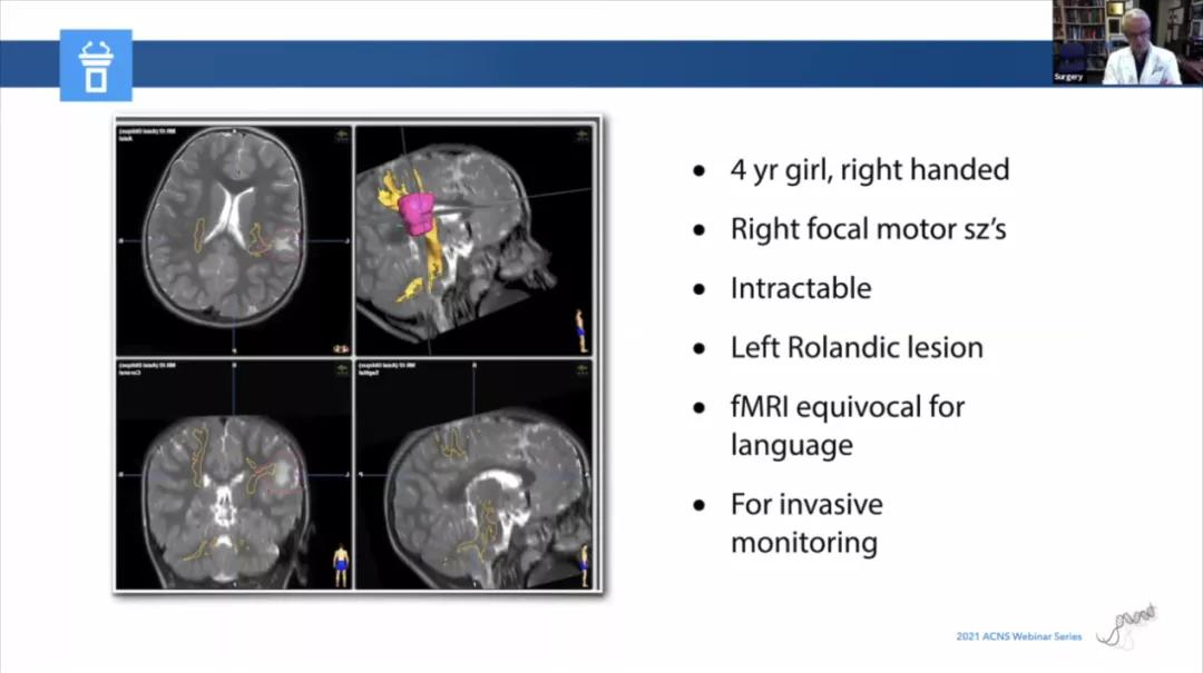 儿童癫痫治愈的真实案例,儿童难治性癫痫有哪些